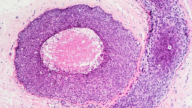 What is 'Stage 0' breast cancer and how is it treated?